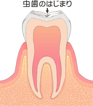虫歯の進行