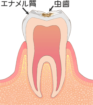 虫歯の進行
