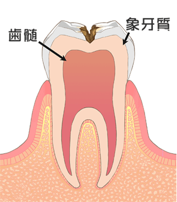 虫歯の進行