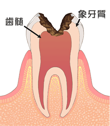 虫歯の進行