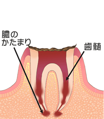 虫歯の進行