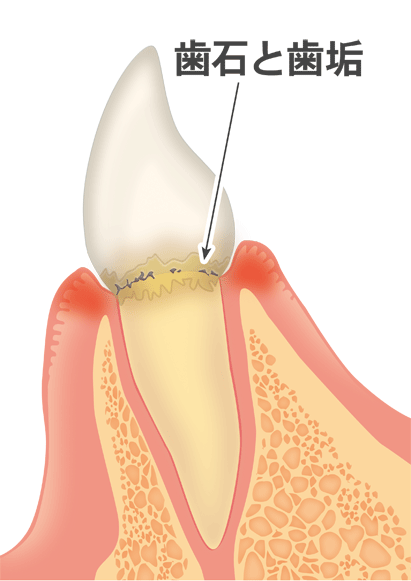 歯周病の進行