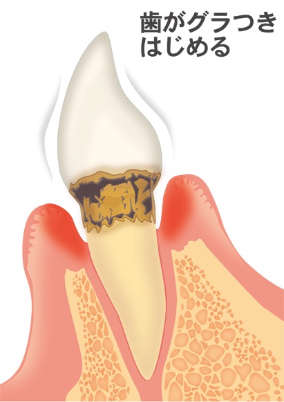 歯周病の進行