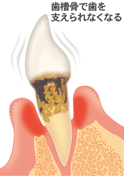 歯周病の進行