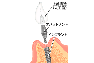 インプラント